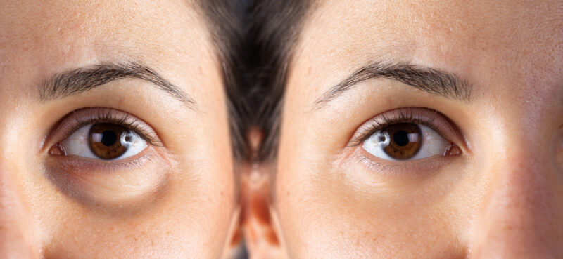 Unexpected Causes of Under-Eye Bags